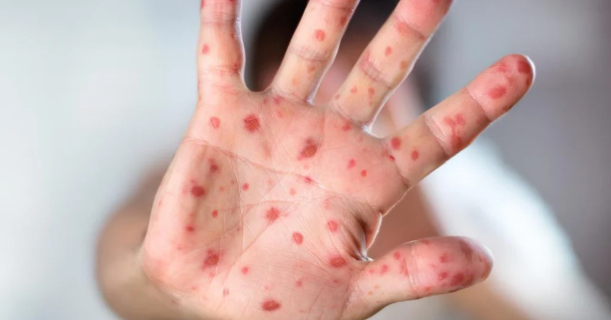 Jalisco reports five cases of Monkeypox; four are foreigners